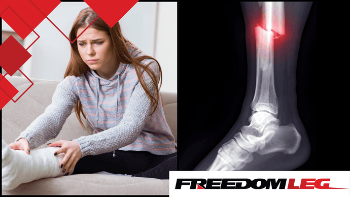 Fibula Fracture: The Road to Recovery