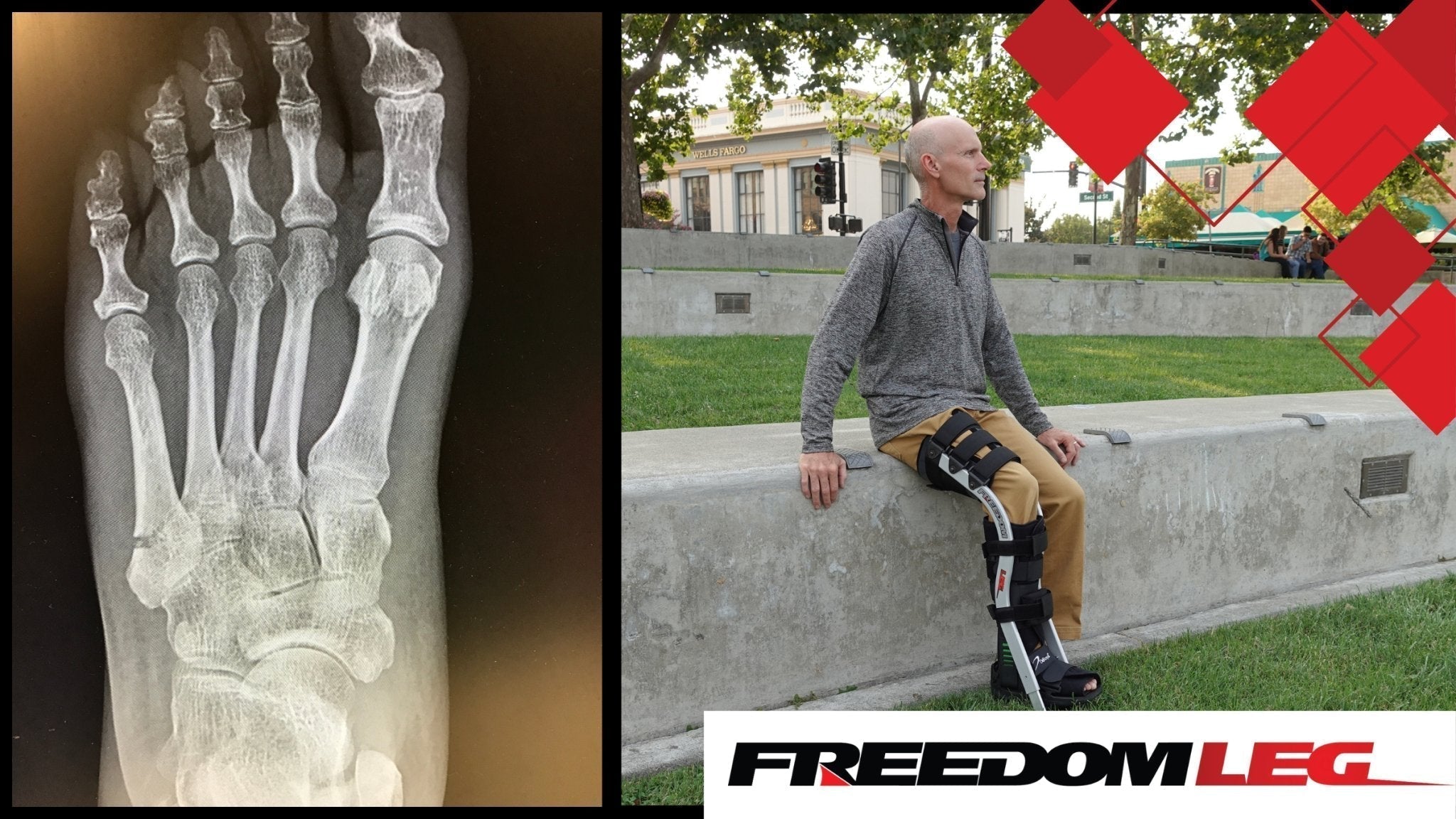 Collage of Jones fracture and man wearing Freedom Leg 
